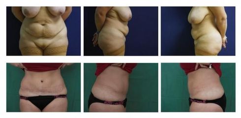 Abdominoplastika 6