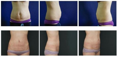 Abdominoplastika 7
