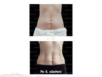 Neinvazivní liposukce před a po - 855516