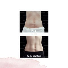 Neinvazivní liposukce - MUDr. Elizabeth (Adenubiová) Pavlíčková, PhD.
