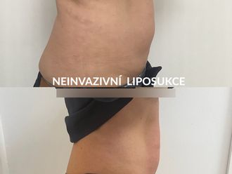 Neinvazivní liposukce před a po - 855517