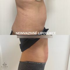 Neinvazivní liposukce - MUDr. Elizabeth (Adenubiová) Pavlíčková, PhD.