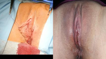 Labioplastika