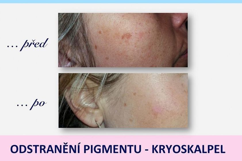 Odstranění pigmentových skvrn před a po - 841725