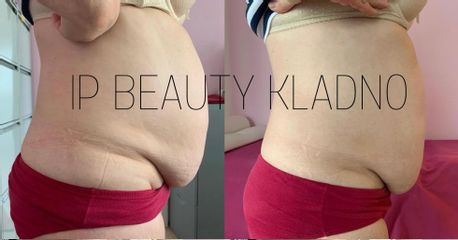 Kavitace - IP Beauty
