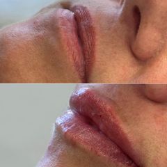 IP Beauty Zvětšení rtů kyselinou hyaluronovou