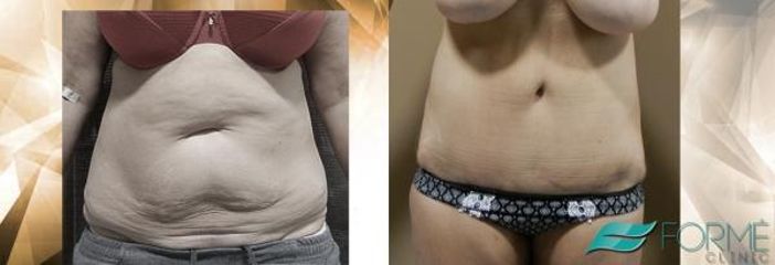 abdominoplastika (2)