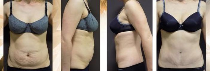 abdominoplastika (3)