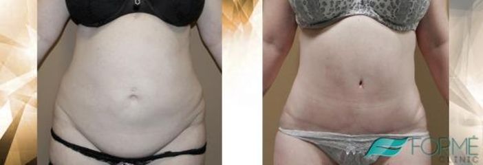 abdominoplastika logo