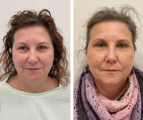 Operace očních víček - MUDr. Lenka Ottová