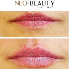 Zvětšení rtů - Neo Beauty Clinic