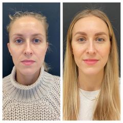 Injekční výplně - Neo Beauty Clinic