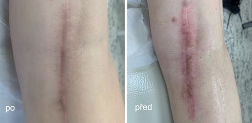 Mezoterapie - Neo Beauty Clinic