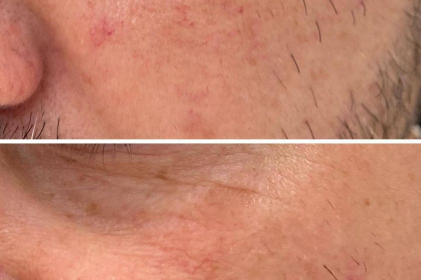 Laserová dermatologie před a po - 862226