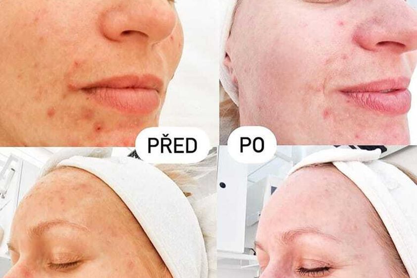 Odstranění pigmentových skvrn před a po - 855051