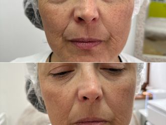 Antiaging před a po - 869307