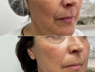 Antiaging před a po - 869308