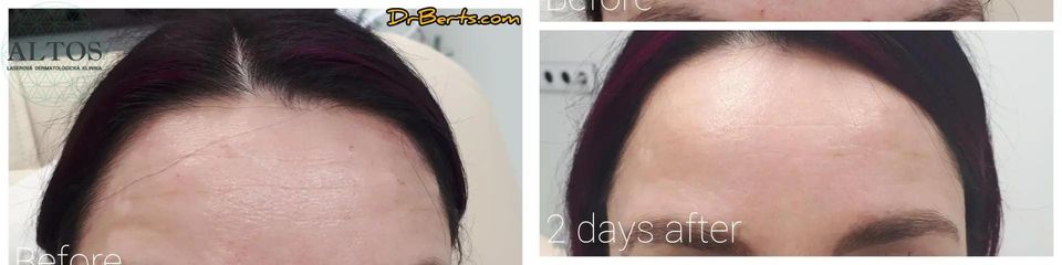 BEFORE 16. Botox