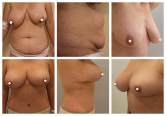 Abdominoplstika - MUDr. Miroslav Veliký