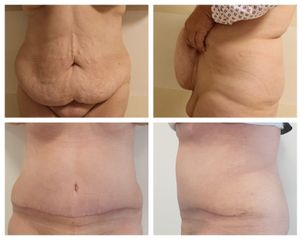 Abdominoplastika - MUDr. Miroslav Veliký