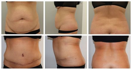 Abdominoplstika - MUDr. Miroslav Veliký