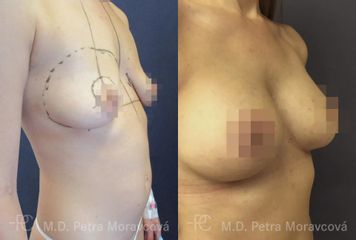 modelace prsu se zvetsenim implantaty PP Pred