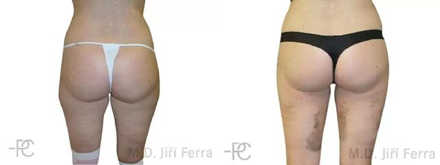 Liposukce stehen a boků pomocí přístroje body jet