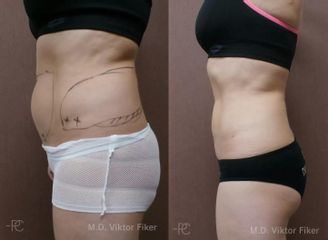 Liposukce