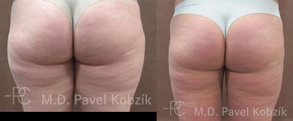 pred lipo kobzik