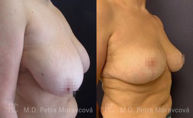 redukce prsu PMK Pred II