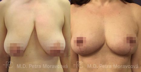 modelace prsu PM Pred I