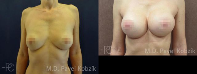 Zvětšení prsou