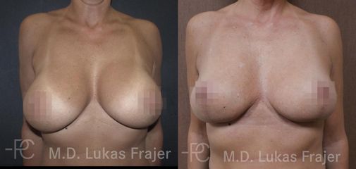 Modelace prsů