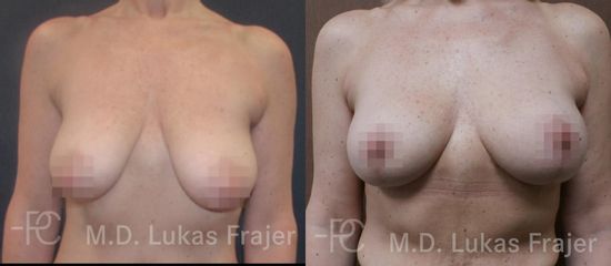 Modelace prsů