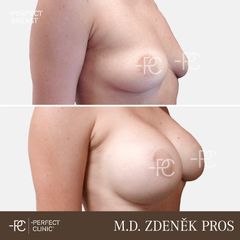 Zvětšení prsou - Perfect Clinic - centrum estetické medicíny