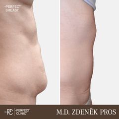 Abdominoplastika - Perfect Clinic - centrum estetické medicíny