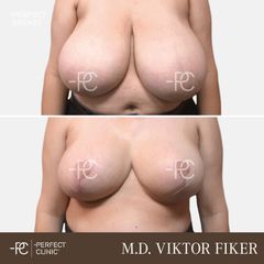 Zmenšení prsou - Perfect Clinic - centrum estetické medicíny