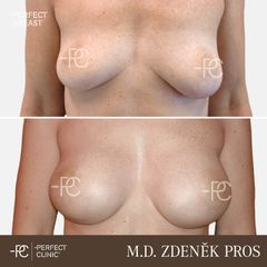 Zvětšení prsou - Perfect Clinic - centrum estetické medicíny