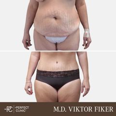 Abdominoplastika - Perfect Clinic - centrum estetické medicíny