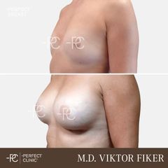 Zvětšení prsou - Perfect Clinic - centrum estetické medicíny