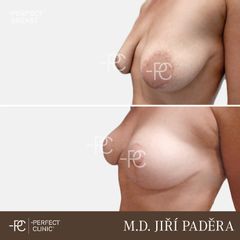Modelace prsou - Perfect Clinic - centrum estetické medicíny