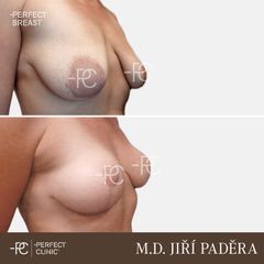 Modelace prsou - Perfect Clinic - centrum estetické medicíny