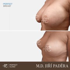 Zmenšení prsou - Perfect Clinic - centrum estetické medicíny