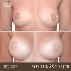 Zvětšení prsou - Perfect Clinic - centrum estetické medicíny