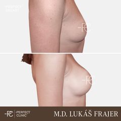 Zvětšení prsou - Perfect Clinic - centrum estetické medicíny