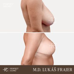 Zmenšení prsou - Perfect Clinic - centrum estetické medicíny