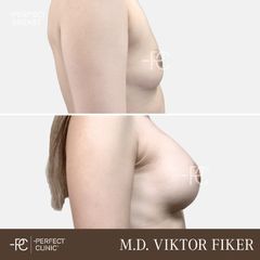 Zvětšení prsou - Perfect Clinic - centrum estetické medicíny