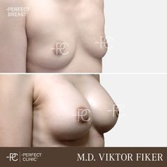 Zvětšení prsou - Perfect Clinic - centrum estetické medicíny