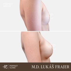 Zvětšení prsou - Perfect Clinic - centrum estetické medicíny