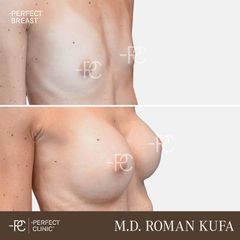 Zvětšení prsou - Perfect Clinic - centrum estetické medicíny